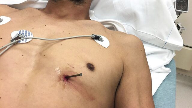 В Висконсине в больницу приехал мужчина с гвоздем в сердце