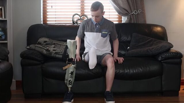 В Северной Ирландии подростку пришили ступню на место колена, чтобы ему было удобнее носить протез