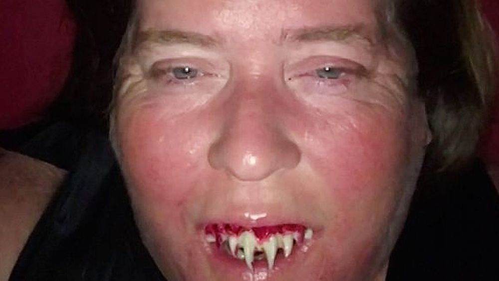 Американке потребовалась помощь стоматолога, чтобы вынуть фальшивые клыки, которая она вставила на Хэллоуин