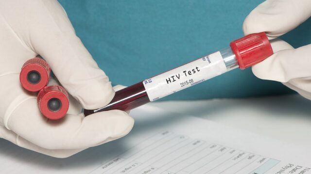 Врачи зафиксировали второй в мире случай полного избавления от ВИЧ без лечения