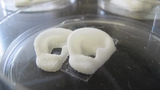 Американке имплантировали напечатанную на 3D-биопринтере ушную раковину