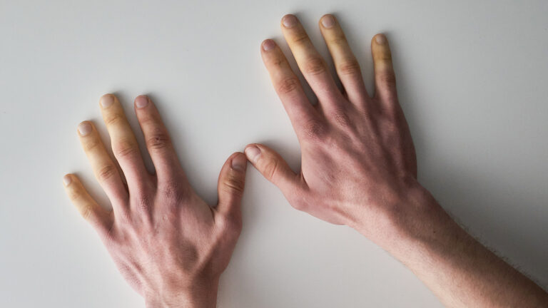Ученые нашли гены, вызывающие синдром белых пальцев