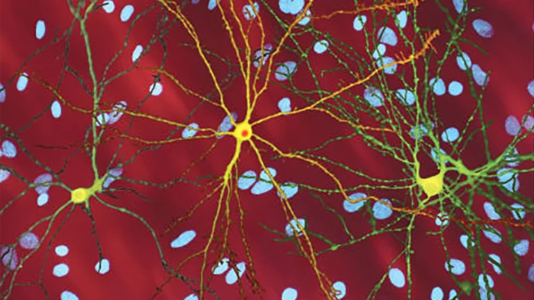 Ученые впервые остановили «неизлечимую» болезнь Гентингтона