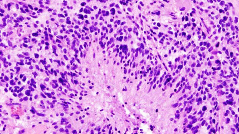 Гистологический срез глиобластомы